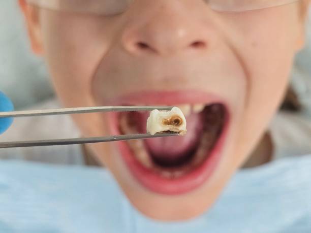 Best Emergency Dentist for Knocked-Out Tooth in Chain Lake, WA